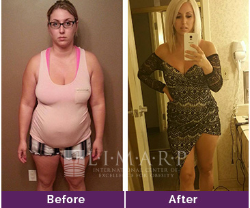 Before and After Gastric Sleeve
