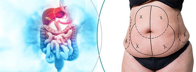 Liposucción abdominal para la mujer - Expertos en Medicina Estética