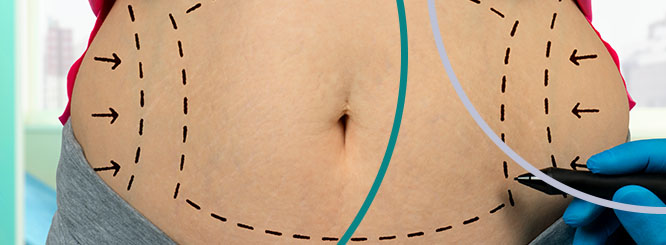 How fat around your organs can affect tummy tuck results