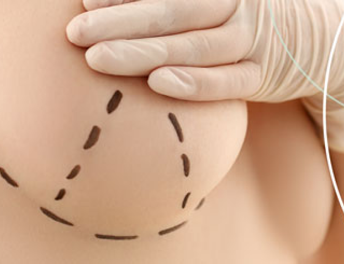 Breast Lift Surgery in Tijuana Mexico: Rejuvenate Your Bust Line with Breast Lift Surgery 1 breast lift tijuana