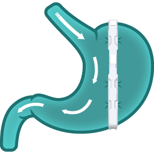 Bariclip en Tijuana México: Alternativa en la lucha contra el sobrepeso y la obesidad 2 Bariclip en Tijuana México