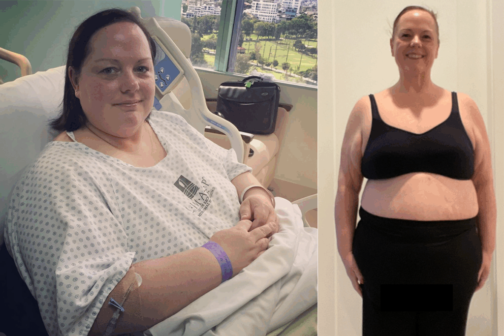 Before and After Gastric Sleeve Surgery Tijuana Mexico